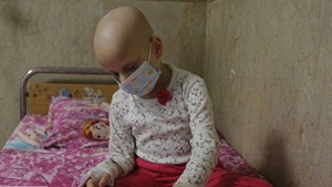 اهمیت و چالشهای رادیوتراپی در درمان سرطان کودکان